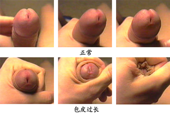 包皮过长的危害是什么呢