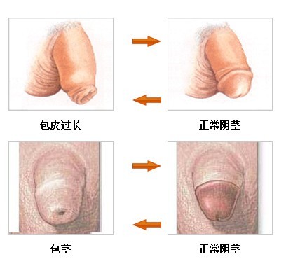 诱发包皮包茎的原因是什么