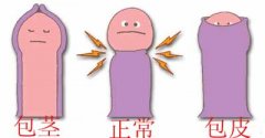 男性包茎的危害有哪些