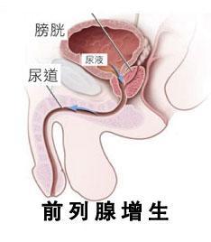 导致前列腺增生的原因都有哪些